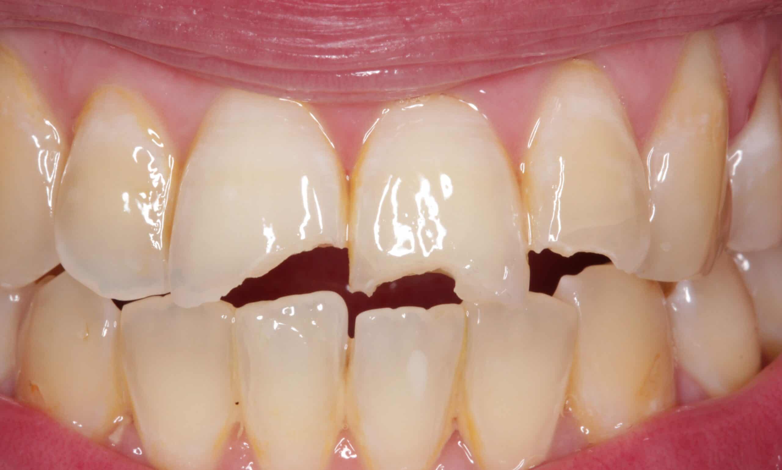 Fractured-teeth-due-to-trauma-before-composite-bonding-scaled